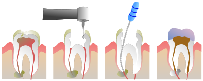 root canal therapy yaletown dentist max dental