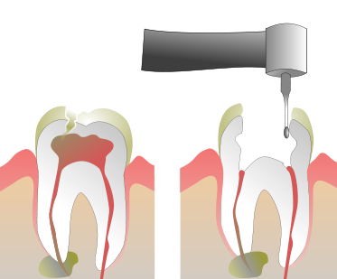 root canal therapy