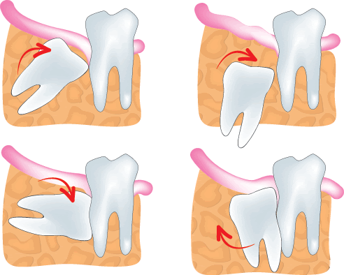 impacted wisdom teeth
